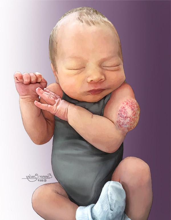 Child with a congenital hemangioma