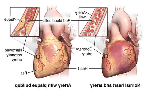 心脏和动脉，显示动脉壁有斑块堆积