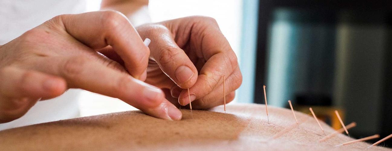 A practitioner performs acupuncture.