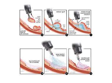 Illustration shows step-by-step process for applying the gel. 