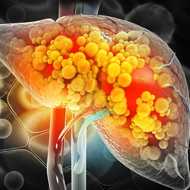 Illustration of a diseased liver