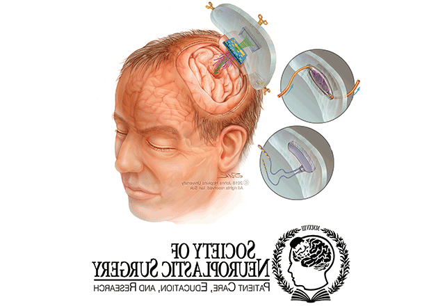 颅脑植入物模型及神经整形外科学会标志